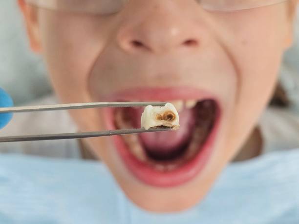 Best Emergency Wisdom Teeth Removal in Harlowton, MT